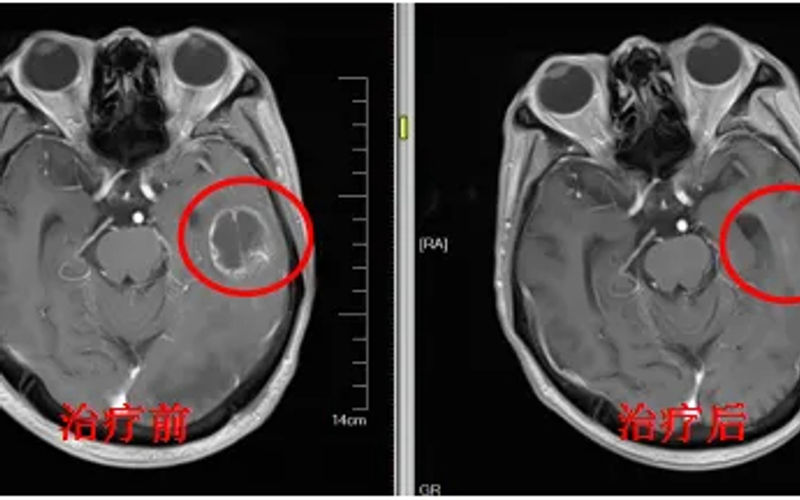 CyberKnife for Brain Tumors: A Radiation Oncologist's In-Depth Explanation