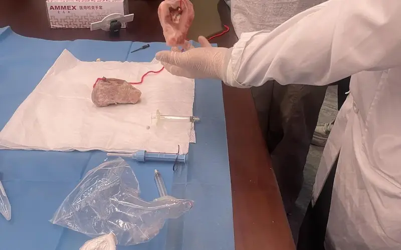 Bone 02: Woman with Lumbar Disc Herniation Cured Without Metal Screws Using Bone Adhesive