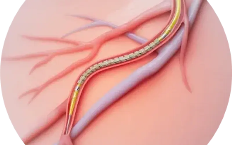 SinoUnited Health Among Shanghai's First to Adopt the Latest-Generation Coronary Stent