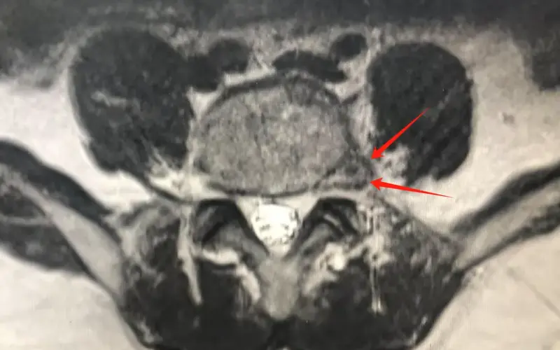 Bệnh viện Não Donglei Thượng Hải: Phẫu thuật xâm lấn tối thiểu 1 cm cho thoát vị đĩa đệm thắt lưng lỗ liên hợp bên