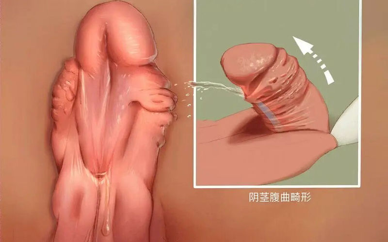Lỗ tiểu thấp phát hiện trên siêu âm tam cá nguyệt hai: Cách chúng tôi giúp trẻ chiến thắng bệnh